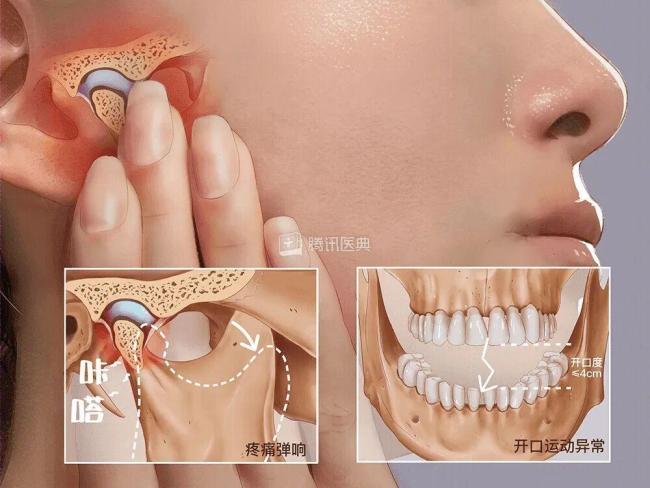 女子壓力過大睡醒無法張嘴 顳下頜關(guān)節(jié)紊亂警示