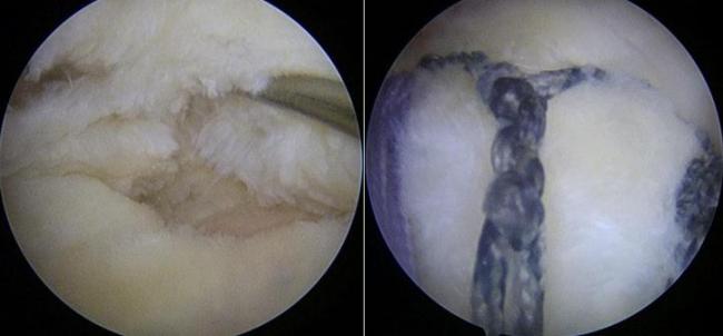 肩袖损伤修复添新招 Y-Loop技术提供解决方案