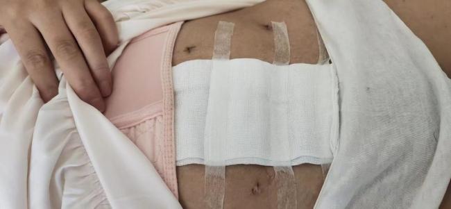 女子取环后子宫穿孔称主刀医生被换 生活创伤难愈合