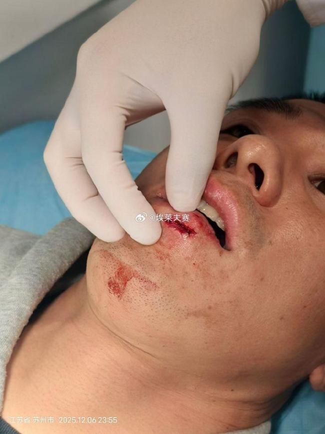 曝侯森縫了23針乘坐火車返回北京