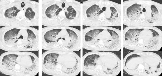 冬天也能“中暑”？警惕“冬季熱射病”