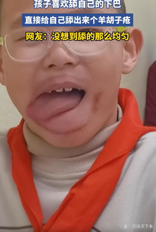 小孩哥舔下巴给自己舔出羊胡子疮 习惯引发的皮肤问题