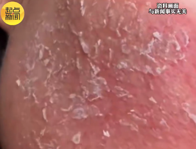 女子以油养肤导致面部疯狂掉皮 医生：过油导致接触性皮炎