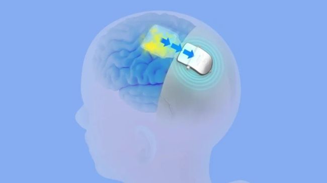 脑机接口见解爆发 险资机构提前布局 迈向营业化时期