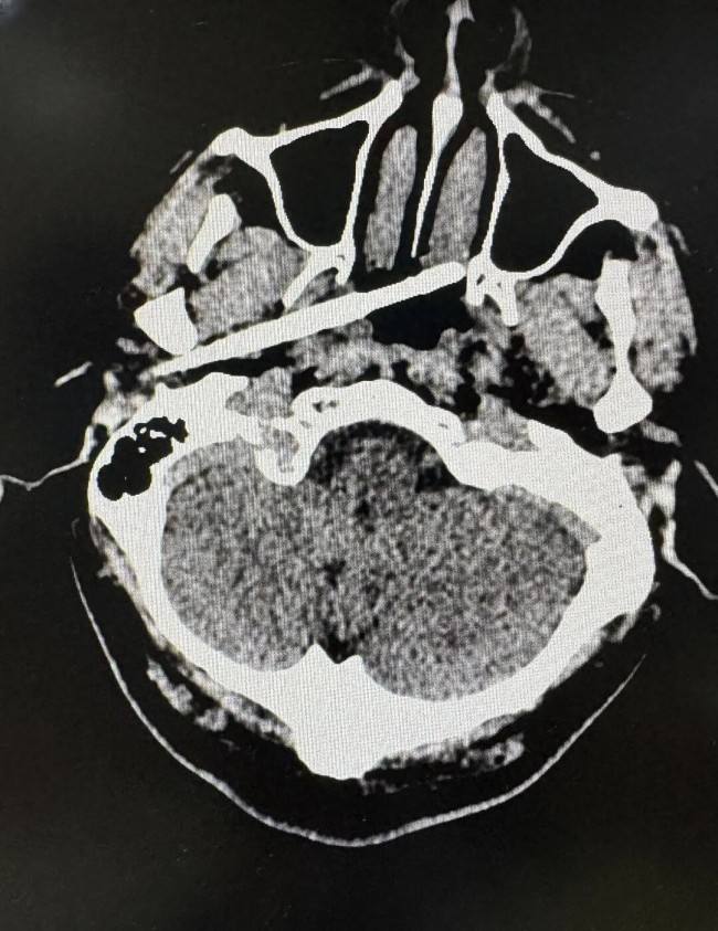 男子被筷子从耳部直插颅底惊险获救 距颈动脉仅5毫米