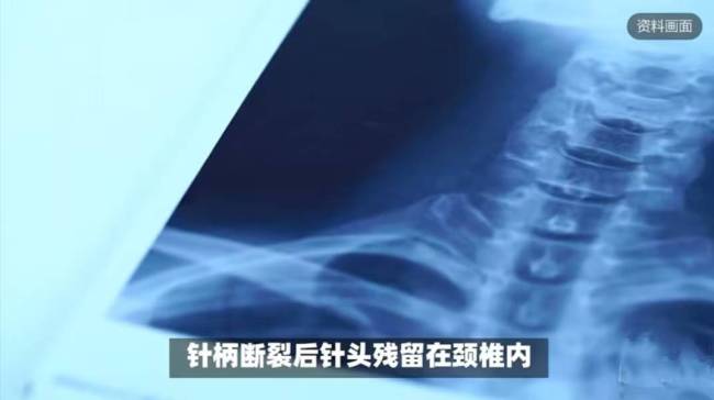 男婴颈椎藏针全身被扎数百针孔 至亲之痛震惊全网