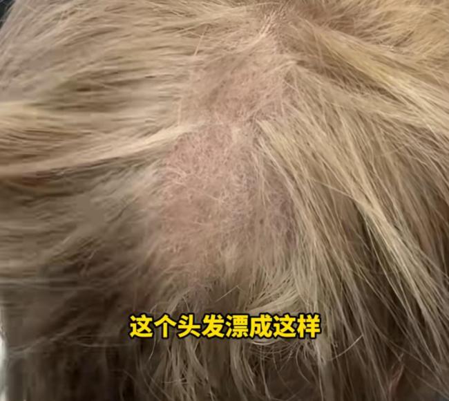 女子漂染头发“翻车” 头皮溃烂长满脓包 头发大片脱落