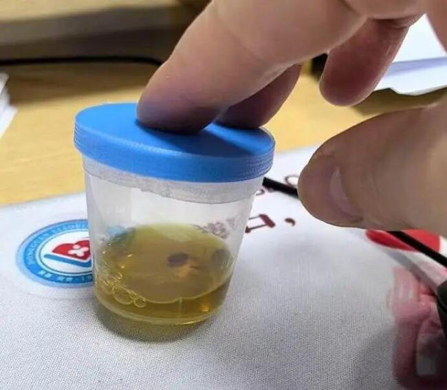 男子吃鱼生后胆管爬满虫子 爱吃鱼生需谨慎