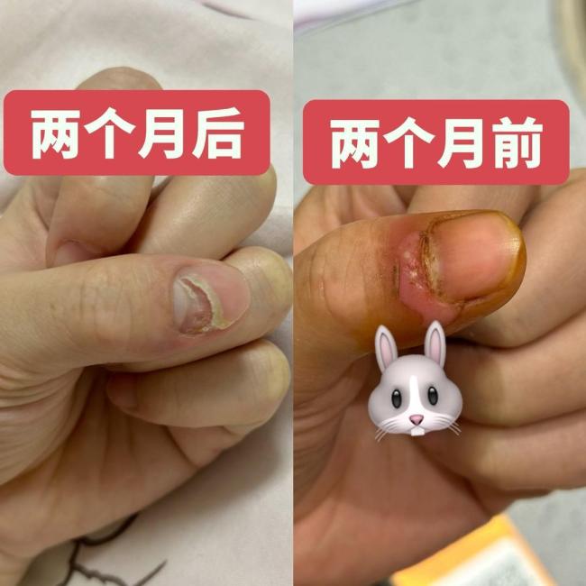 女子拔倒刺指甲开裂险截肢