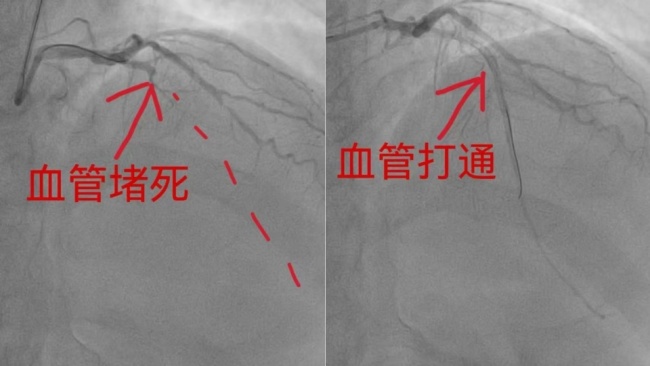 男子呕吐硬扛12小时查出心梗