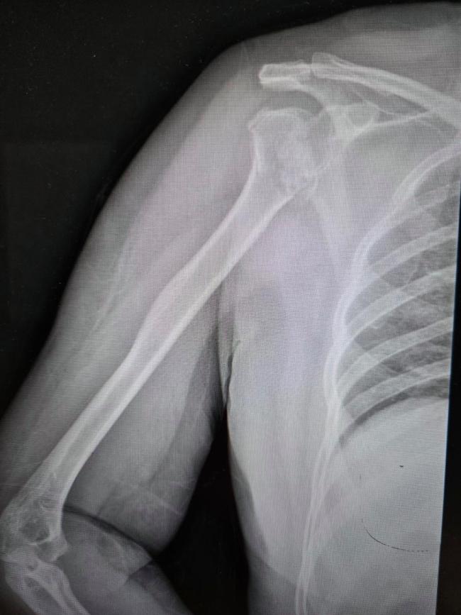 50岁大姐睡觉时粉碎性骨折 癫痫发作所致