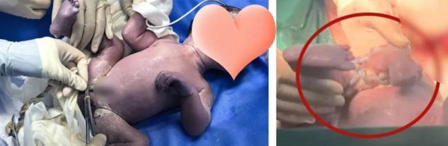 胎儿变懒竟因脐带扭转30圈 医生提醒