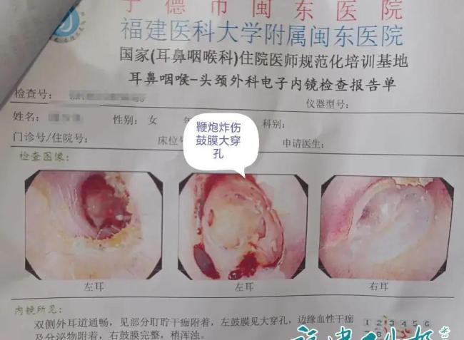 女子看热闹鼓膜被震出大窟窿 礼炮声中的“看不见的危险”