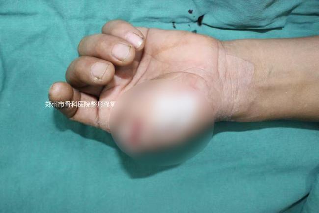 男子手指被绞碎医生为其接上脚趾头 成功恢复手部功能