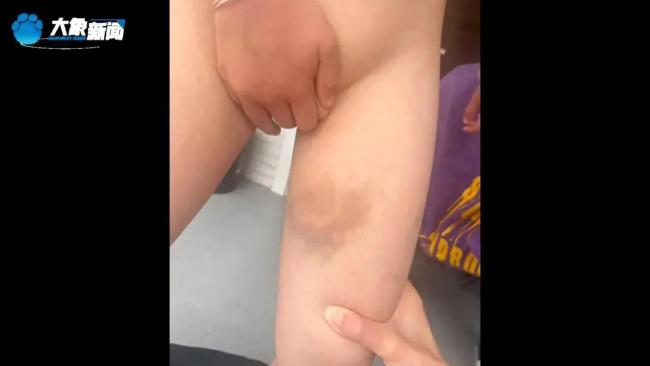 湖南姐弟俩遭继母生父虐待长达5年 满身伤痕触目惊心