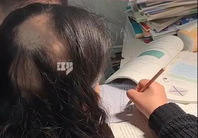 85后宝妈遭遇鬼剃头