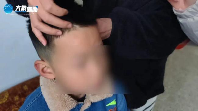 湖南姐弟俩遭继母生父虐待长达5年 满身伤痕触目惊心