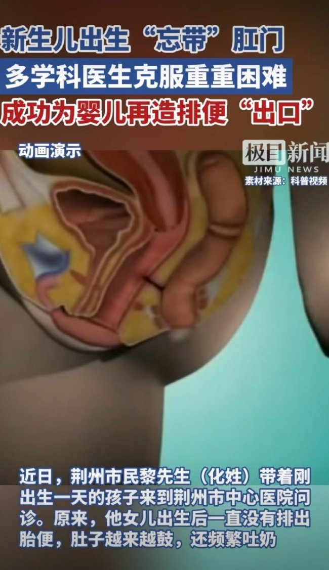 新生儿出生“忘带”肛门 医生成功救治