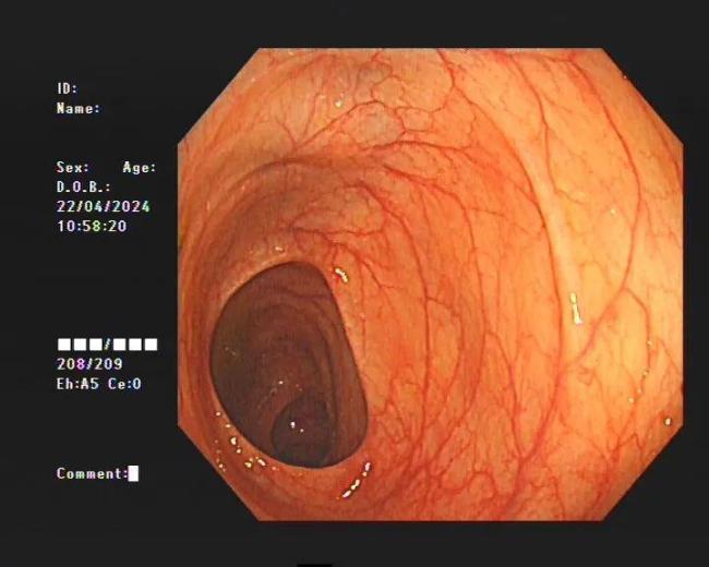 女子便秘10年被切30厘米肠管 长期滥用通便茶的代价
