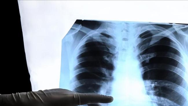 有结节的人要在春天做4件事 谨慎防护