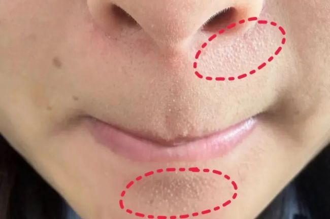 为什么下巴会长小颗粒