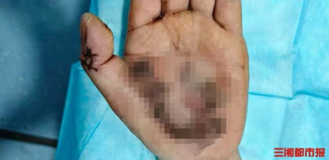 男子高压塔下洗手遭电击重伤险截肢