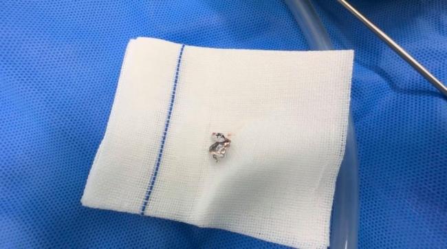 8个月女婴误食花生米大小锡箔纸