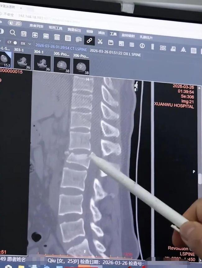 女生下楼梯玩手机踩空致腰椎骨折 一场意外改变一生