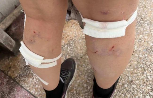 校方回应女生被群狗围堵咬伤20多处 当事人：幸亏有人骑电动车撞开狗群