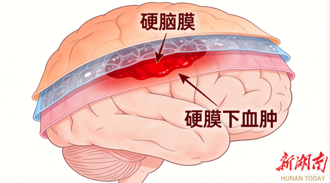 长沙女子感冒后颅内再出血 咳嗽引发险情