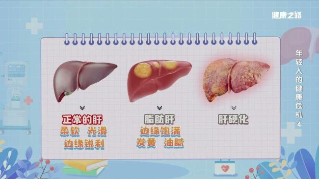脂肪肝悄悄盯上年轻人 不良习惯成主因