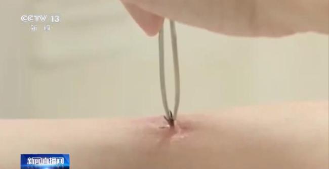 医生从患者身上拔出17只蜱虫