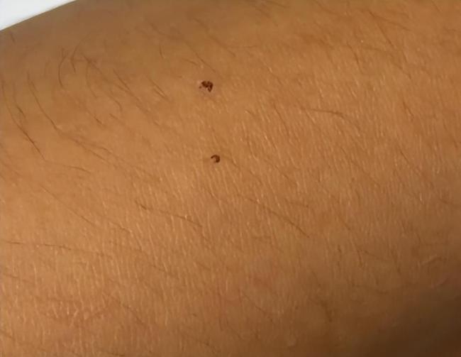 初中生被蛇咬 上课视力模糊以为近视 险些危及生命
