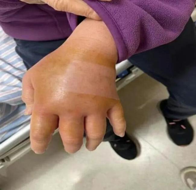海鲜可能诱发致命感染 这种伤口要小心
