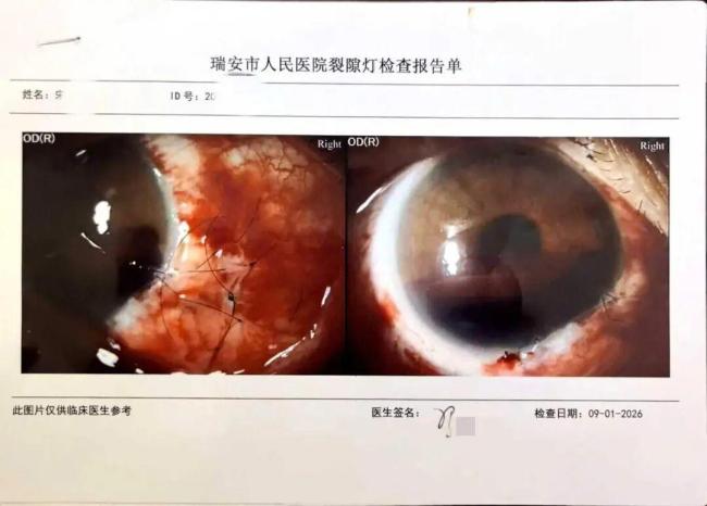 女教师劝架被女生用镊子戳伤眼球 创伤后应激障碍缠身