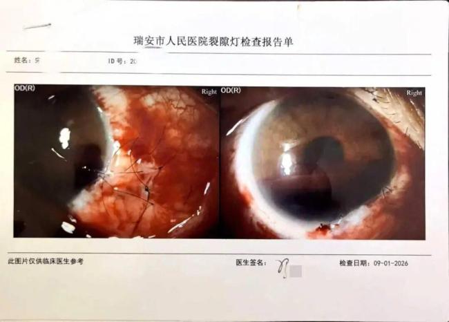 教师劝架被戳伤眼球涉事学生家长回应 家长表达歉意并愿担责