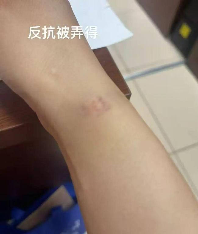住院女子胸部拭子中检出男医生DNA 涉事医生已被开除