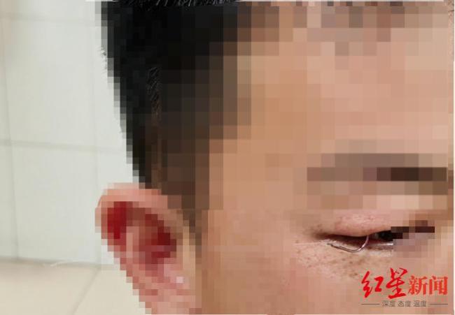 男子钓鱼甩钩不慎刺入右眼皮