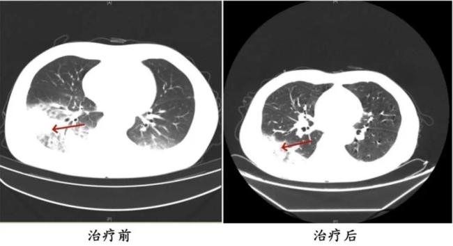 小心空調(diào)里藏著看不見的刺客軍團(tuán) 警惕軍團(tuán)菌肺炎