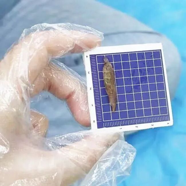 女子不慎吞下棗核腹痛難忍 醫(yī)生:這個(gè)壞習(xí)慣很多人都有