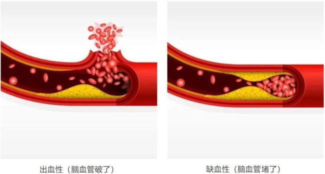 3个看似无关的表现或是中风前兆 身体早有预警信号