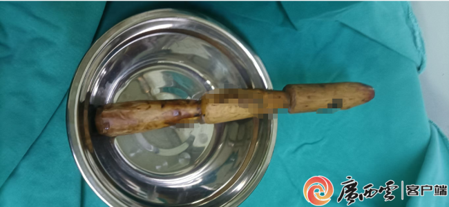 7旬大爷便秘用木棍疏通致肠穿孔