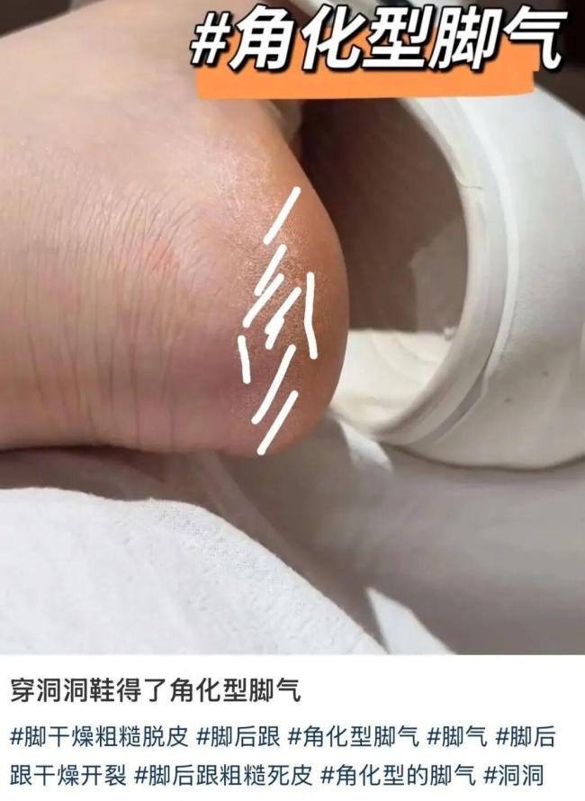 广东人爱穿洞洞鞋小心脚气 潮湿环境增风险