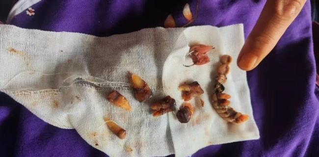 媒体评老人看一颗牙被拔十二颗牙 医院涉嫌过度医疗