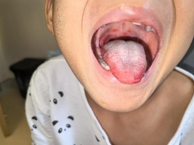 近期手足口病高发 春夏季流行高峰来临
