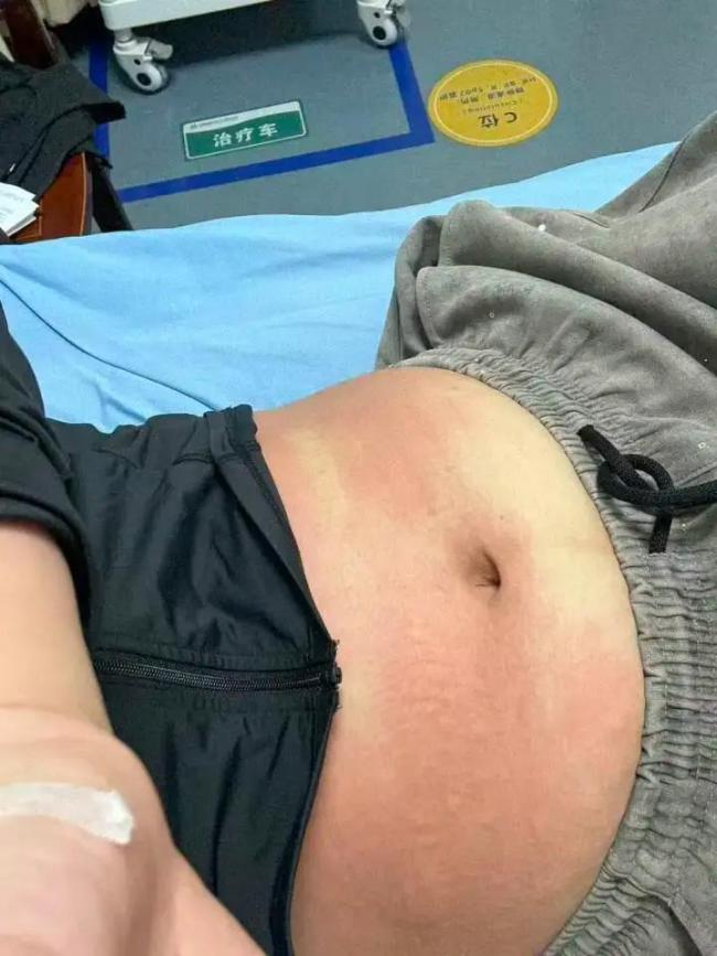 女子吃完虾马上健身差点没命 死神来了般的经历
