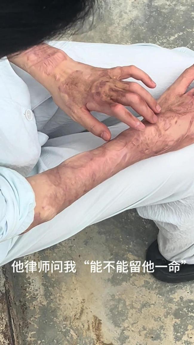 泼硫酸男子被执死刑受害人发声 正义已到,生活仍难