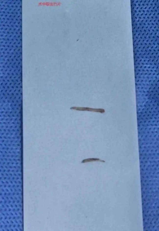 女孩误吞筷子竹片完全不知道 边吃饭边看手机惹祸