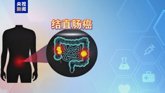 肠癌发现就是中晚期？身体这些信号千万别忽视 警惕年轻化趋势