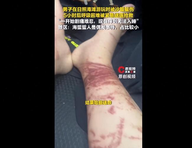男子被沙蜇蜇伤5小时后呼吸困难